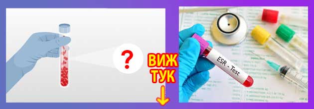 Как да намалим СУЕ Причини, лечение, изследване 2